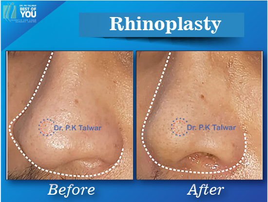 rhinoplasty surgery result